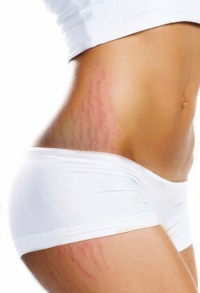 Удаление растяжек – восстанавливающие процедуры