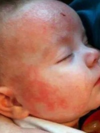 аллергические красные точки аллергические красные точки