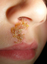 стрептодермия заражение стрептодермия заражение