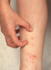 Кожный клещ лечение – выбор наиболее эффективного метода