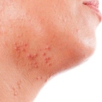 Удаление кондилом в домашних условиях: рекомендации народных целителей