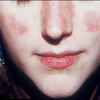 Что такое системная красная волчанка или просто волчанка?