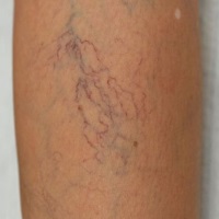 Как избавиться от сосудистых звездочек на ногах: какой метод удаления выбрать