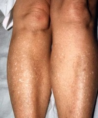 фолликулярный кератоз фолликулярный кератоз