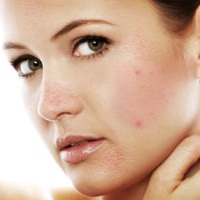 прыщи типы невоспаленных угрей прыщи типы невоспаленных угрей