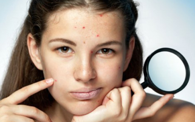 средства против прыщей средства против прыщей